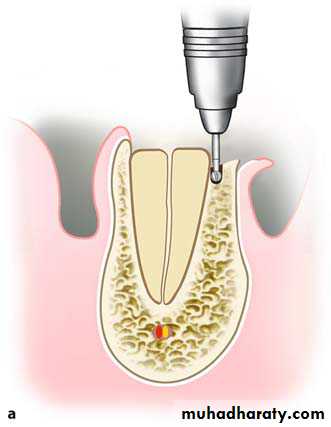 Impaction