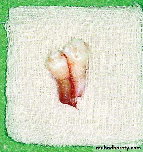 Impaction