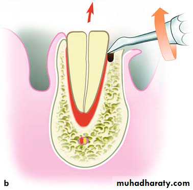 Impaction