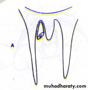 Impaction