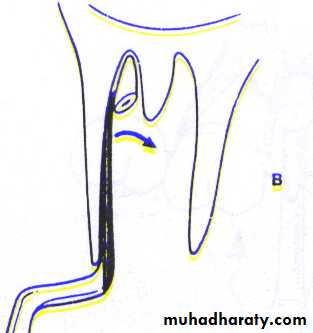 Impaction
