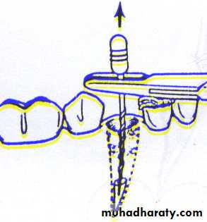 Impaction
