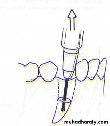 Impaction