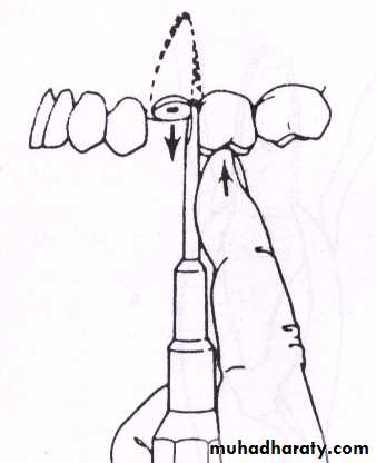 Impaction
