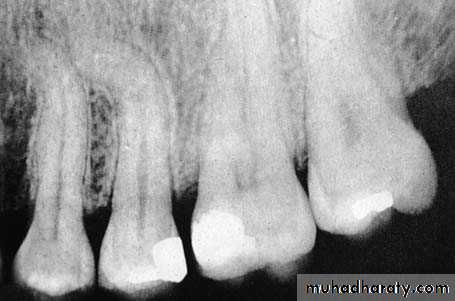 Impaction