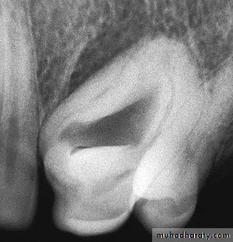 Impaction