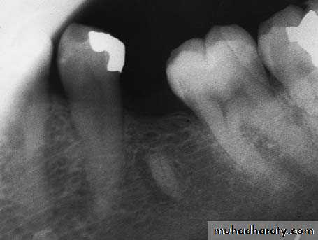 Impaction