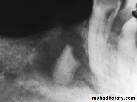 Impaction