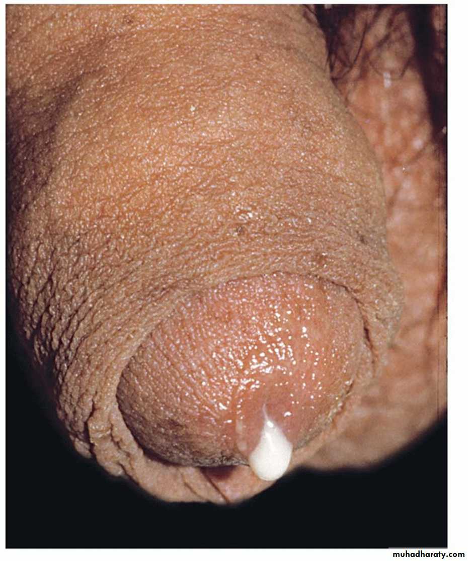 urethritis