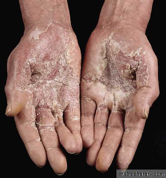 Eczema