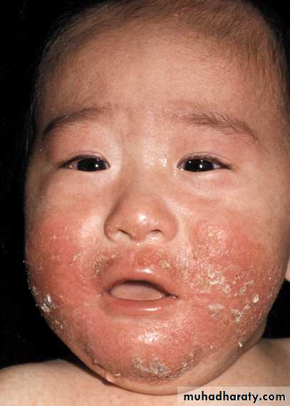 Eczema