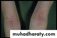Eczema