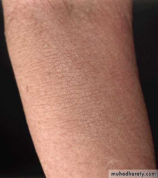 Eczema
