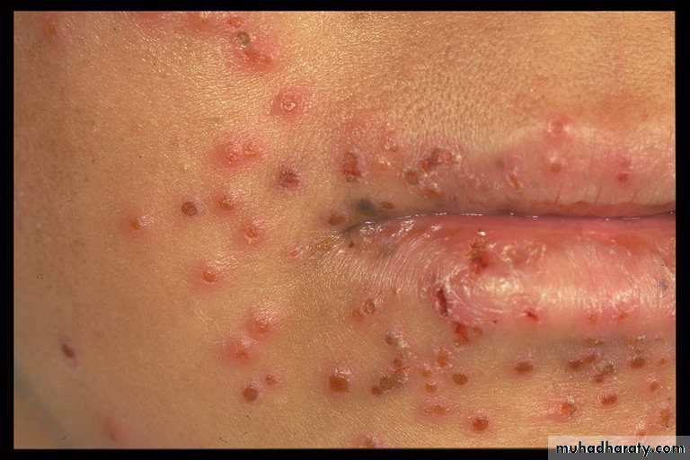 Eczema