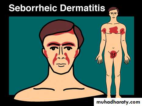 Eczema