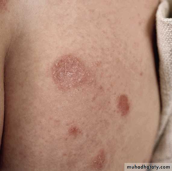 Eczema