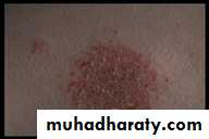 Eczema