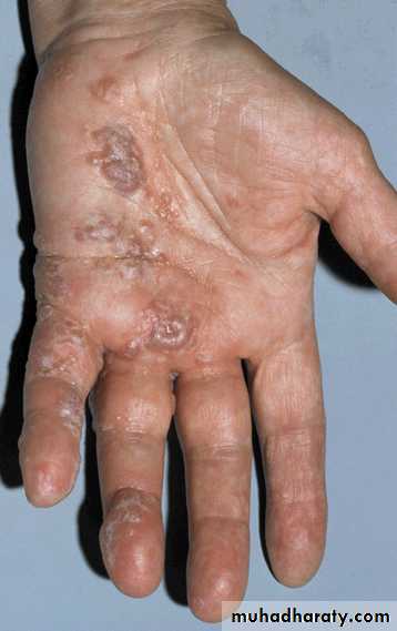 Eczema