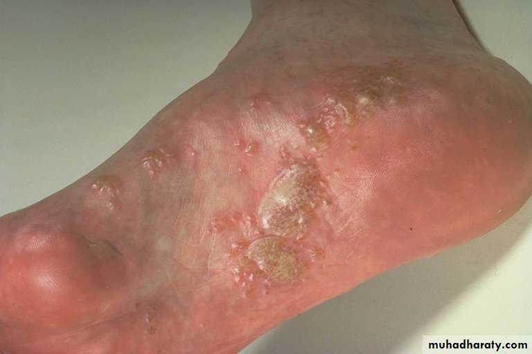 Eczema