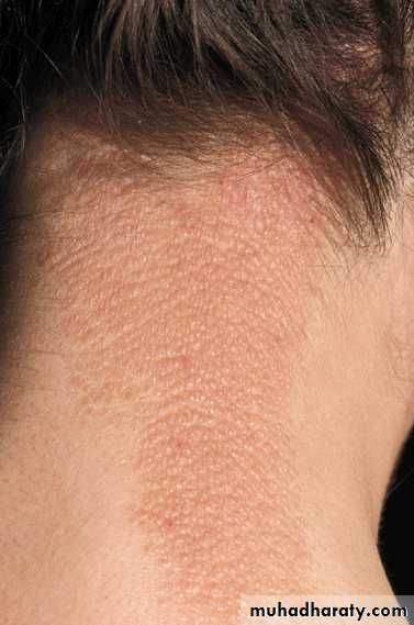 Eczema