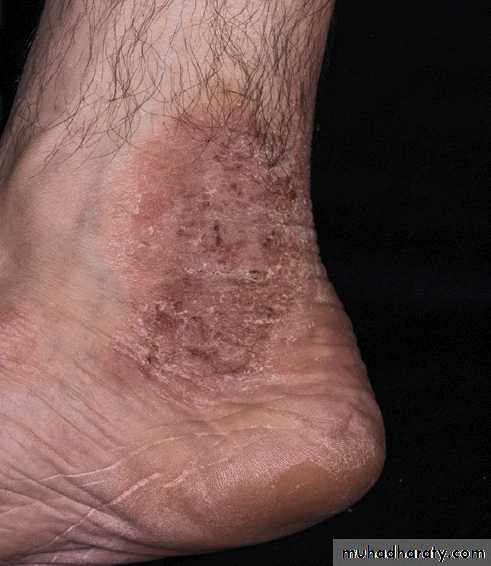 Eczema