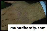 Eczema