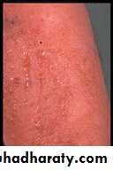 Eczema