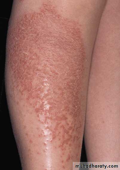 Eczema