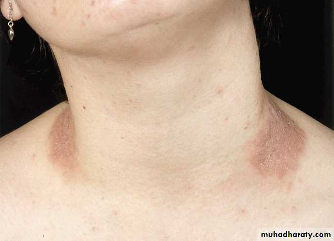 Eczema