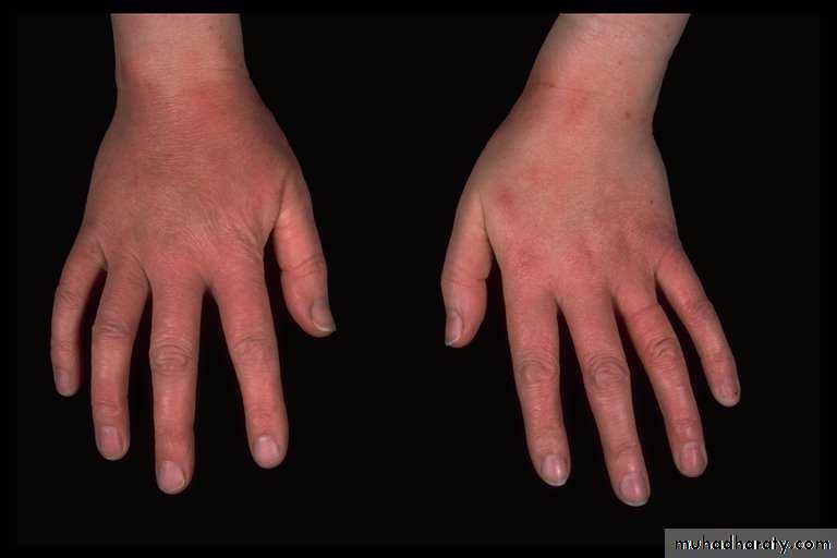 Eczema