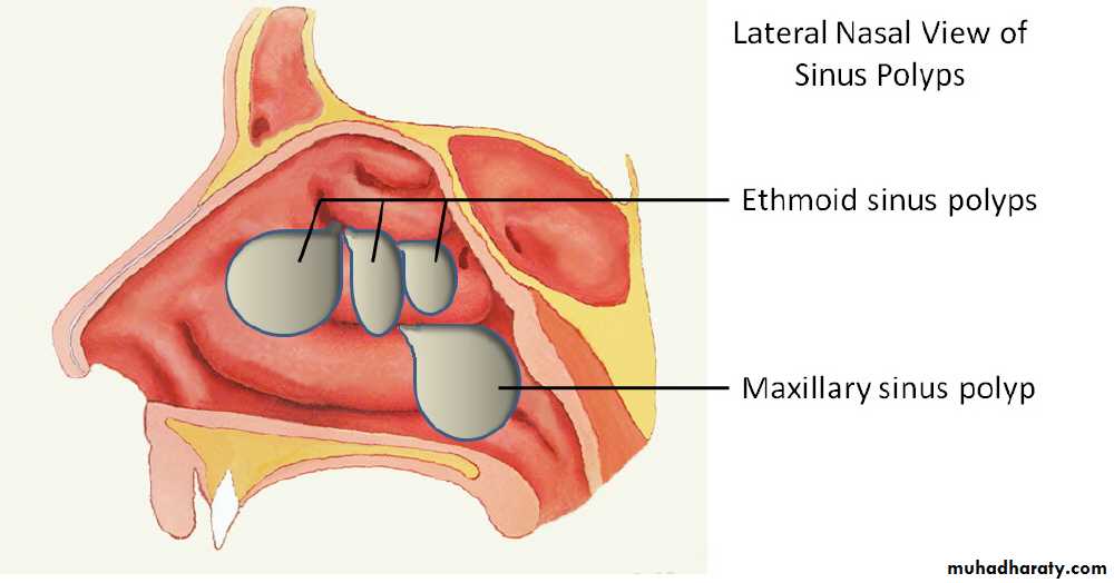 Vasomotor rhinitis