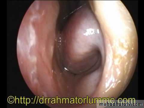Vasomotor rhinitis