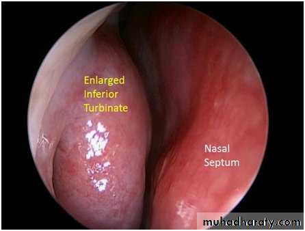 Vasomotor rhinitis