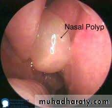 Vasomotor rhinitis