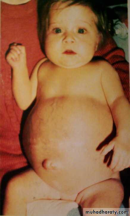Hyperbilirubinemia in the new born