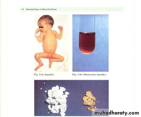 Hyperbilirubinemia in the new born