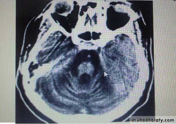 Ataxia