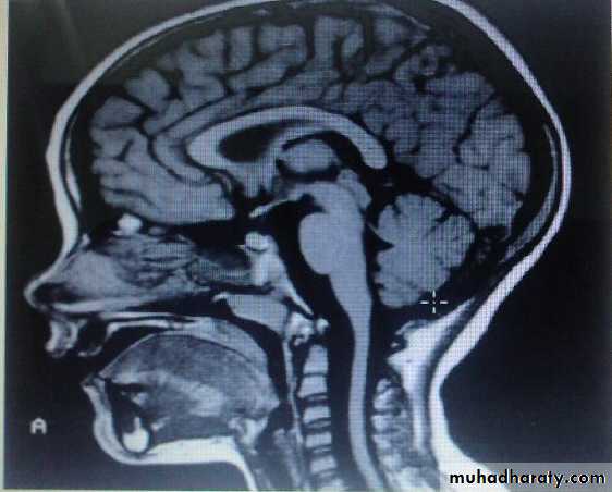 Ataxia