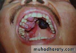 pigmented lesion of oral mucosa