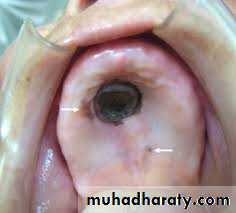 pigmented lesion of oral mucosa