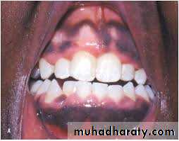 pigmented lesion of oral mucosa