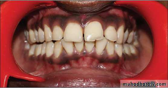 pigmented lesion of oral mucosa