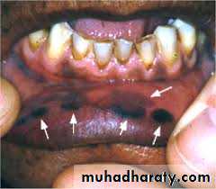 pigmented lesion of oral mucosa