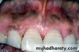 pigmented lesion of oral mucosa