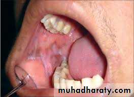 pigmented lesion of oral mucosa