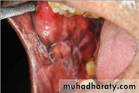 pigmented lesion of oral mucosa