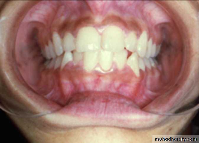 pigmented lesion of oral mucosa