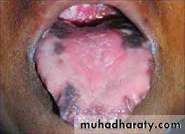 pigmented lesion of oral mucosa