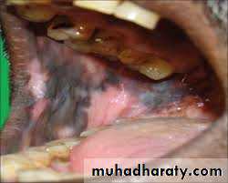 pigmented lesion of oral mucosa