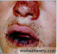 pigmented lesion of oral mucosa